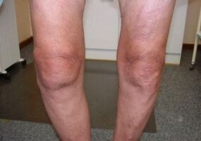 How to treat airtrosis of the knee component