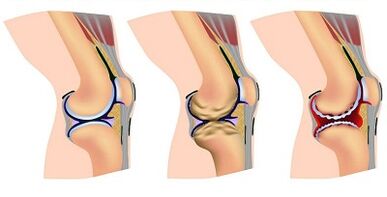 Airtrosis development stages of the knee component