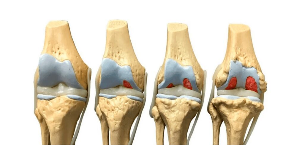 level of arthrosis of the joints